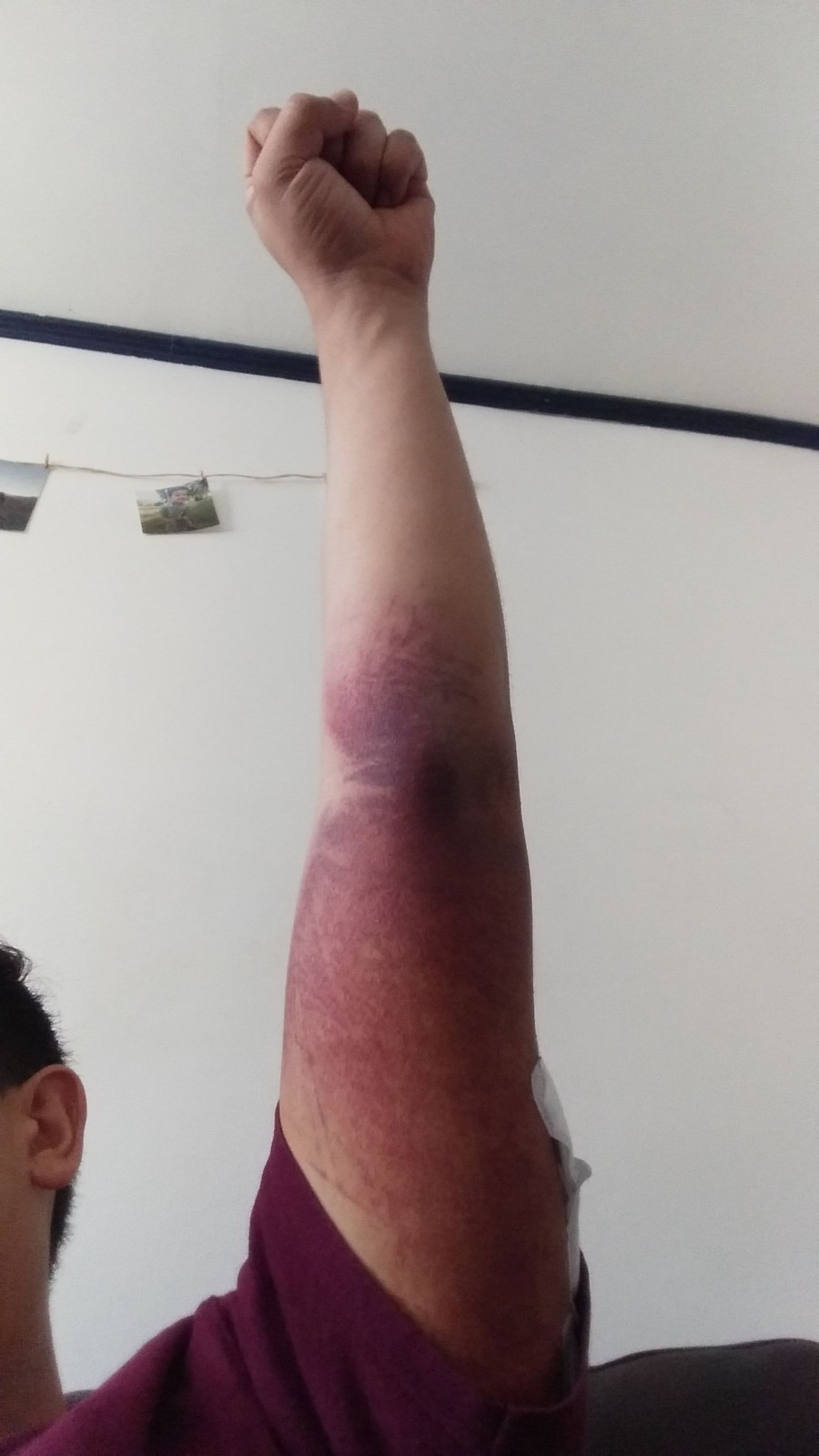 Brazo lesionado de Guerrero tras disparo de lacrimógena.