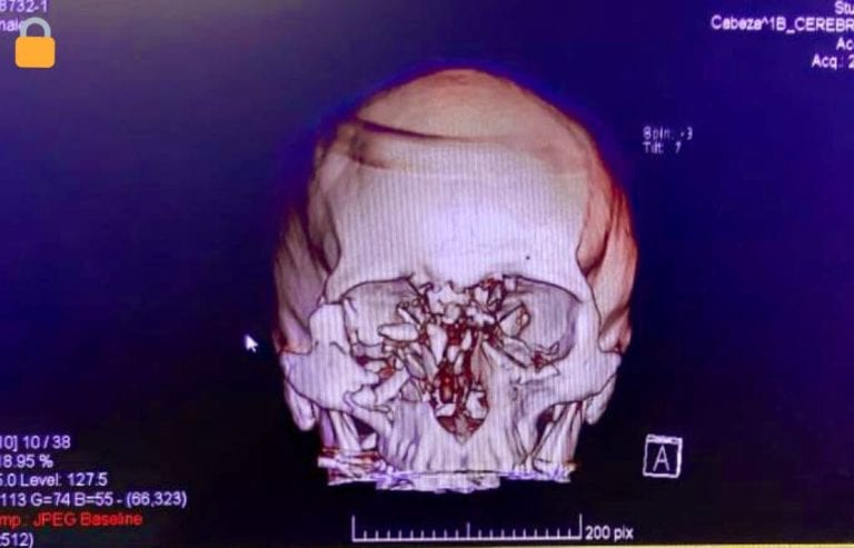Radiografía del cráneo de Fabiola Campillai luego del disparo.