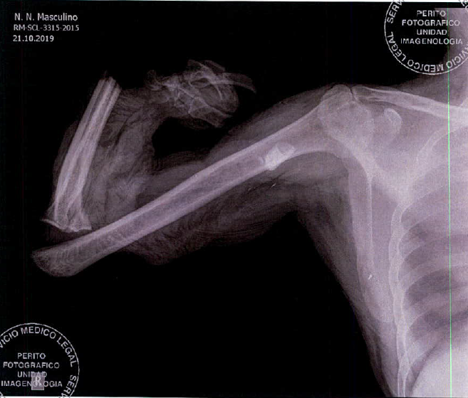 Radiografía de Andrés Ponce con un objeto radiopaco desconocido en su brazo derecho Radiografía de Andrés Ponce con un objeto radiopaco desconocido en su brazo derecho