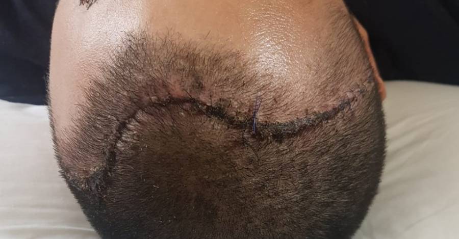 Foto de Juan Carlos Pereira, operado por un golpe de lacrimógena en su cráneo