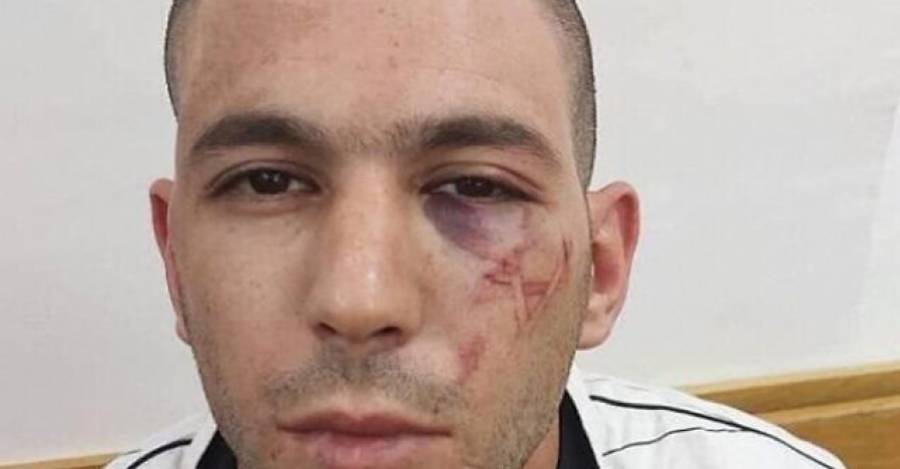 Marca en la cara de Ali luego de detención policial