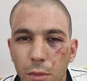 Marca en la cara de Ali luego de detención policial Marca en la cara de Ali luego de detención policial